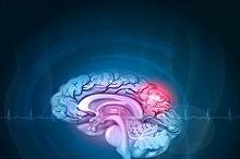 年轻人急性缺血性卒中后 近半数使用他汀缩略图