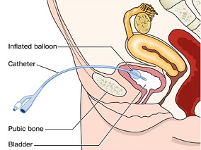 转移性尿路上皮癌免疫治疗的网络荟萃分析 仅一种二线治疗有生存获益缩略图