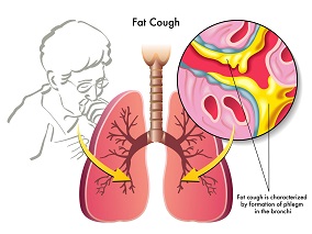 妥布霉素吸入溶液用于支气管扩张伴铜绿假单胞菌感染成人效果如何？缩略图