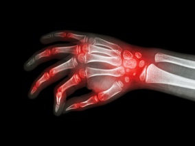糖皮质激素有效性、疗程和安全性：一项系统评价为2022年EULAR更新类风湿关节炎治疗建议提供信息缩略图