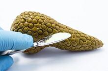 2型糖尿病患者使用胰高血糖素样肽-1受体激动剂 胰腺癌风险知多少缩略图