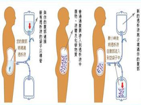 腹膜透析：生物相容性溶液是标准溶液的一种有效替代缩略图