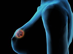 肉芽肿乳腺炎的临床特征和治疗缩略图