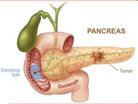 二甲双胍不能改善晚期胰腺癌患者的生存结局缩略图