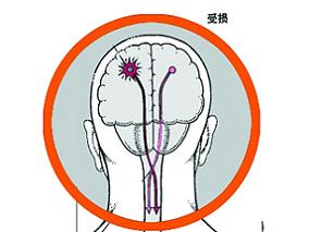 卒中前无法自理患者vs能独立生活的患者溶栓治疗的结局和并发症缩略图