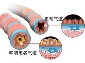 持续哮喘患者吸入氟替卡松：白天给药vs夜晚给药缩略图