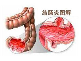 他克莫司和抗TNF治疗难治性溃疡性结肠炎的安全性和有效性缩略图