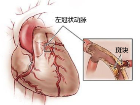 经皮介入治疗治疗左主干病变的长期预后缩略图