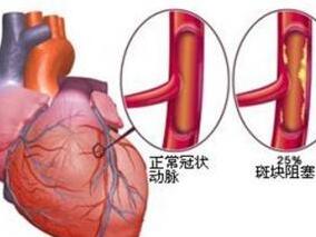 非阻塞性冠心病治疗进展缩略图