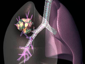 肺癌免疫治疗的思考缩略图